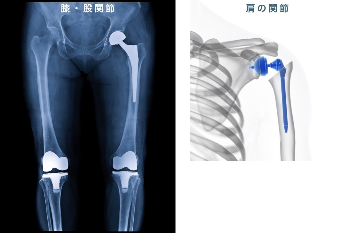 変形性関節症 | 部位・症例解説 | 一宮市の整形外科・リハビリ｜森整形