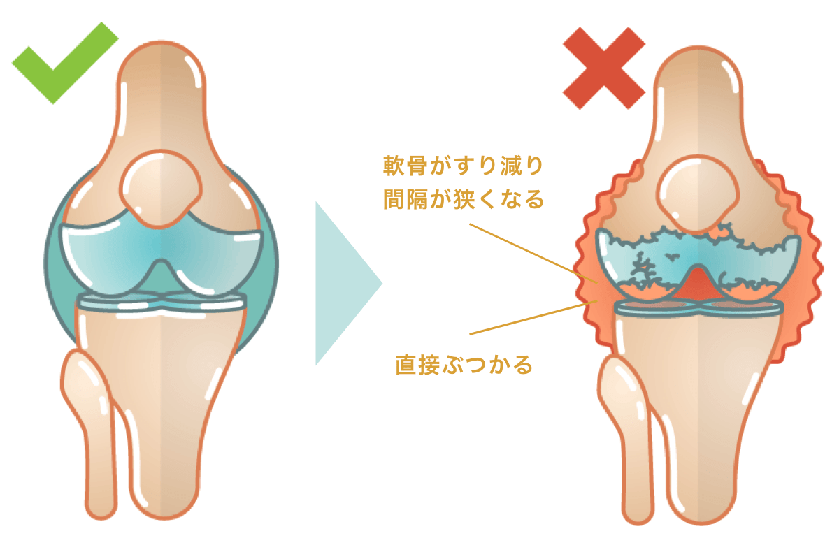 OA 患者の長期的な見通しは何ですか?