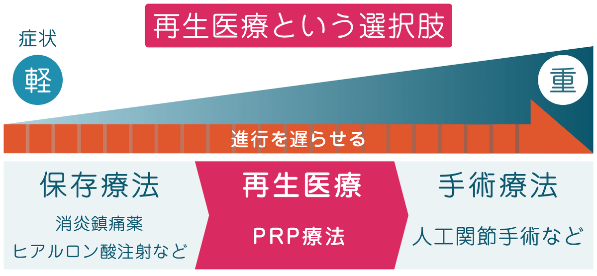 一宮市森整形外科の膝の再生医療PFC-FD（PRP-FD）療法の説明図