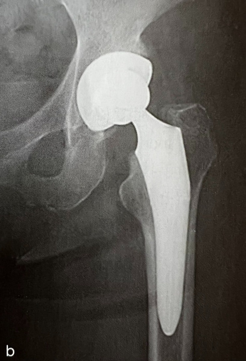 特発性大腿骨頭壊死のレントゲン写真2