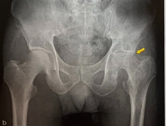 特発性大腿骨頭壊死のレントゲン写真1