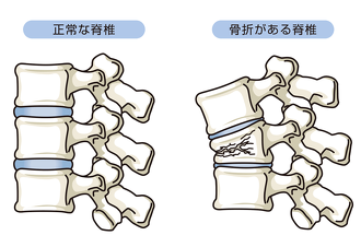 正常な脊椎と骨折のある脊椎の比較図