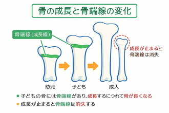 骨端線の説明図