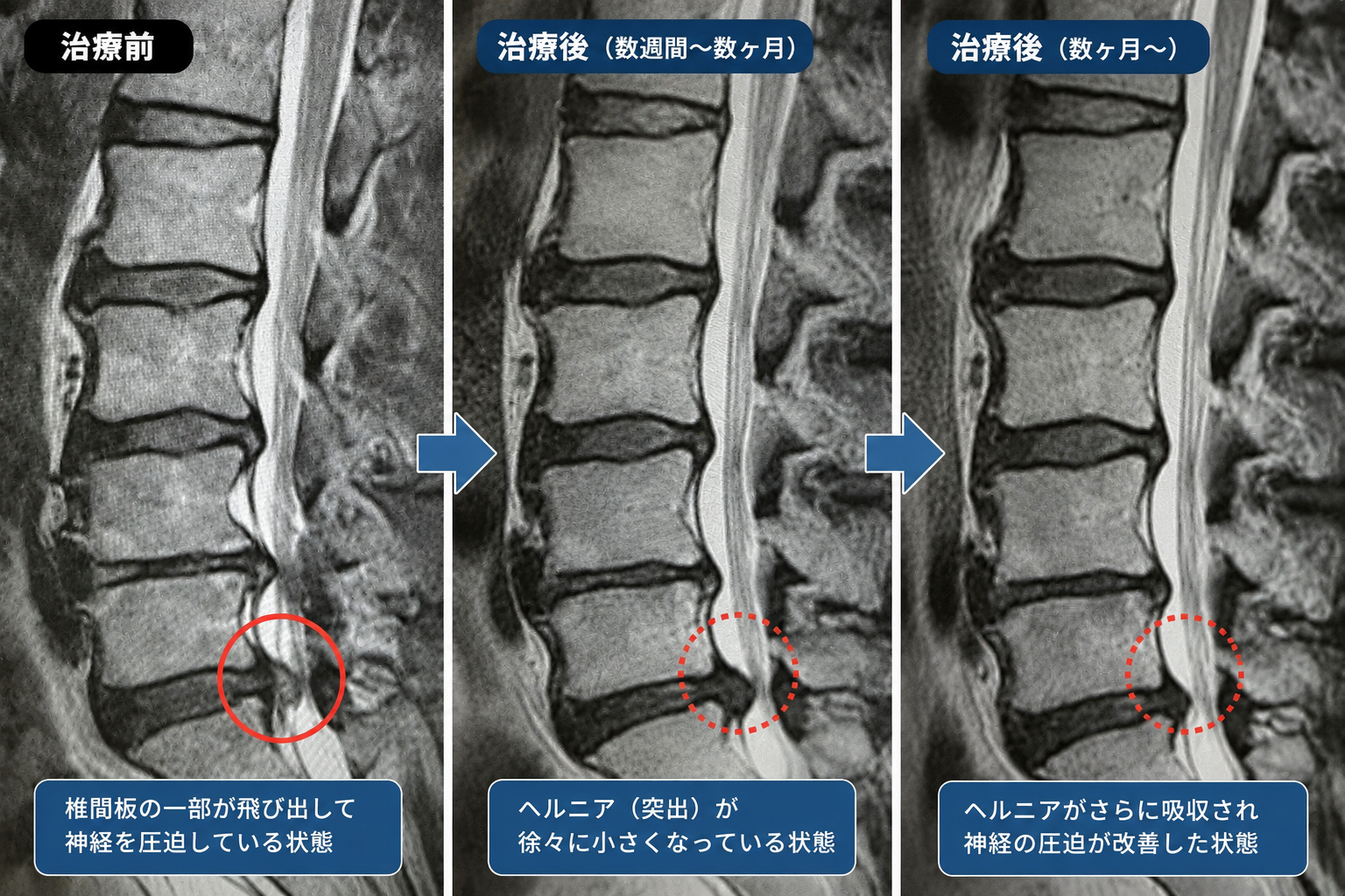 ヘルニア患者 ヘルニアは手術しないと治らない？ ― 実は“自然に小さくなる”ことも
